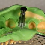 Riproduzione dei tessuti molli nella protesi su impianti