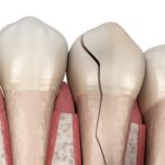 Fratture dentali: classificazione, prognosi e trattamento Frattura dentale, prognosi e trattamento