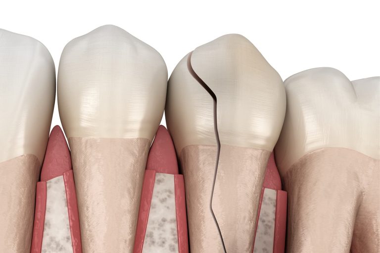Fratture dentali: classificazione, prognosi e trattamento