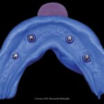 Riproduzione dei tessuti molli nella protesi su denti naturali