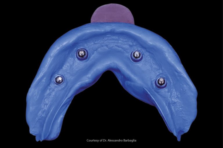 Riproduzione dei tessuti molli nella protesi su denti naturali