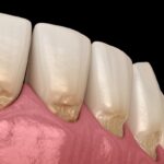 Abrasione, erosione e abfrazione dentale: quali sono le differenze? Abrasione, erosione e abfrazione
